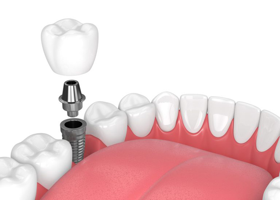 Canton Mi Dental Implant Dentists