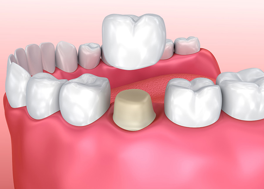 Dental Crowns Canton Michigan Dentists