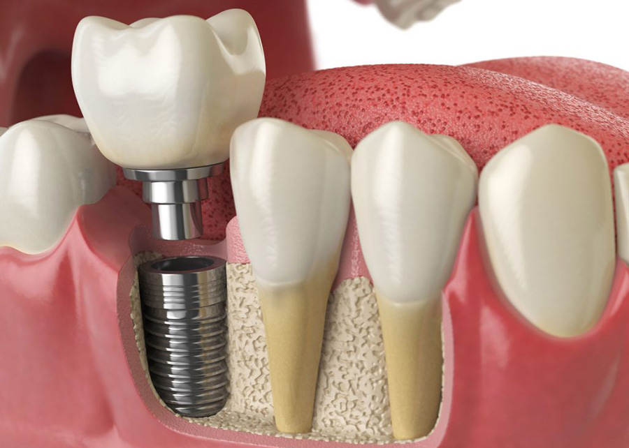 Dental Implant Dentists Near Me