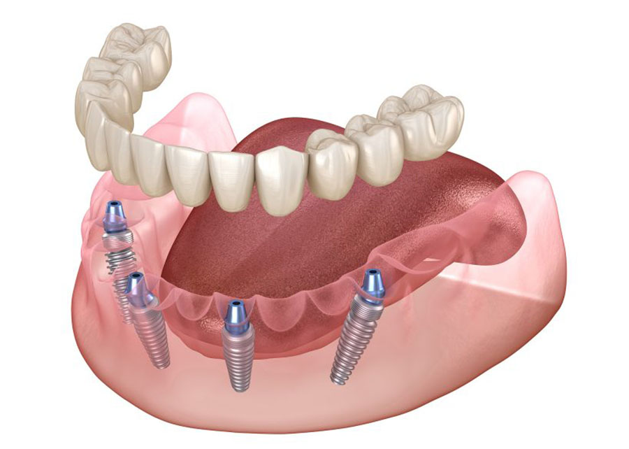 Dental Implant Dentists Near Me