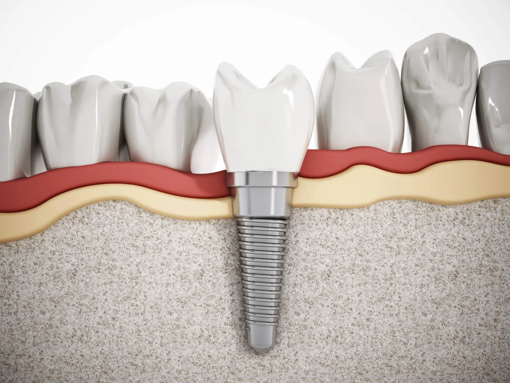 Illustration-Showing-Dental-Implants-In-Canton