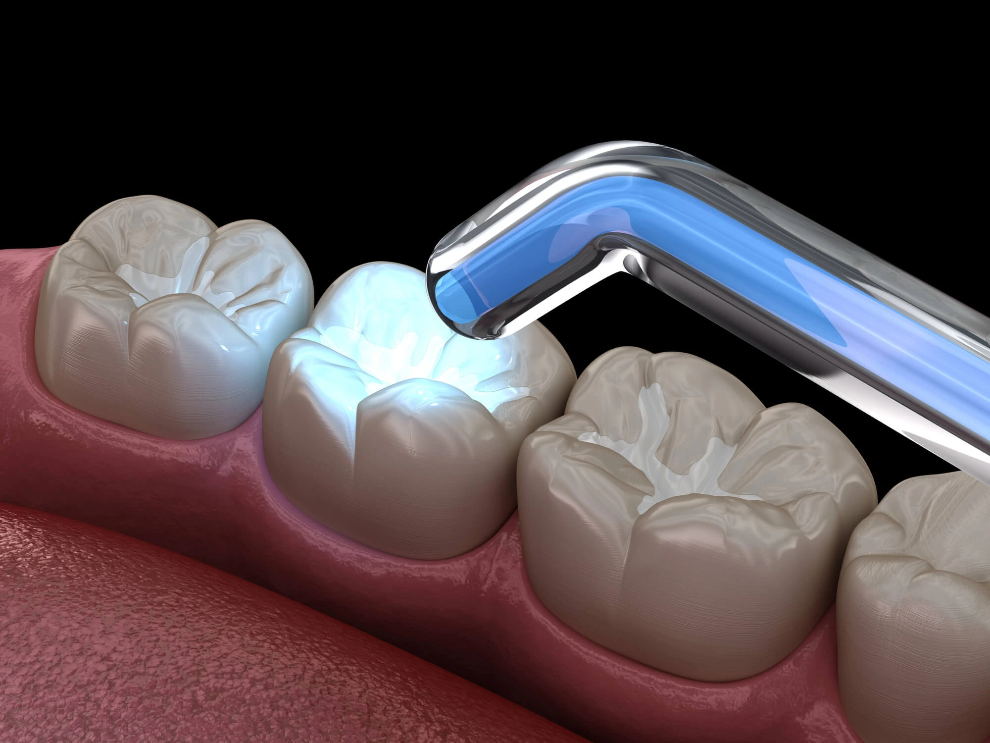 Tooth Restoration With Dental Fillings In Canton Michigan And Polymerization Lamp