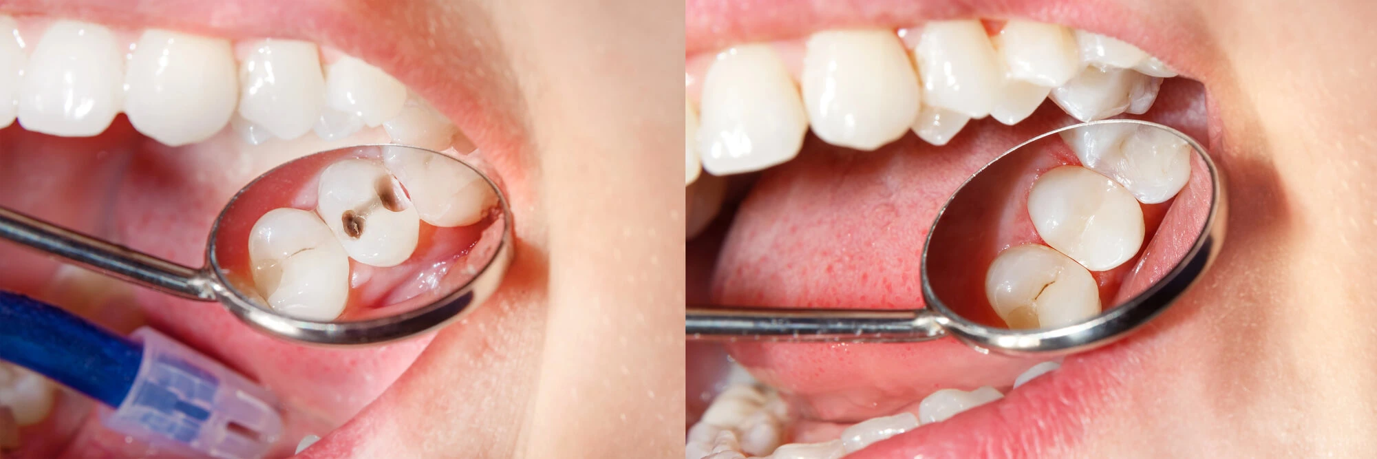 Dental Fillings In Canton Michigan With Dental Composite Photopolymer Material Using Rabbders