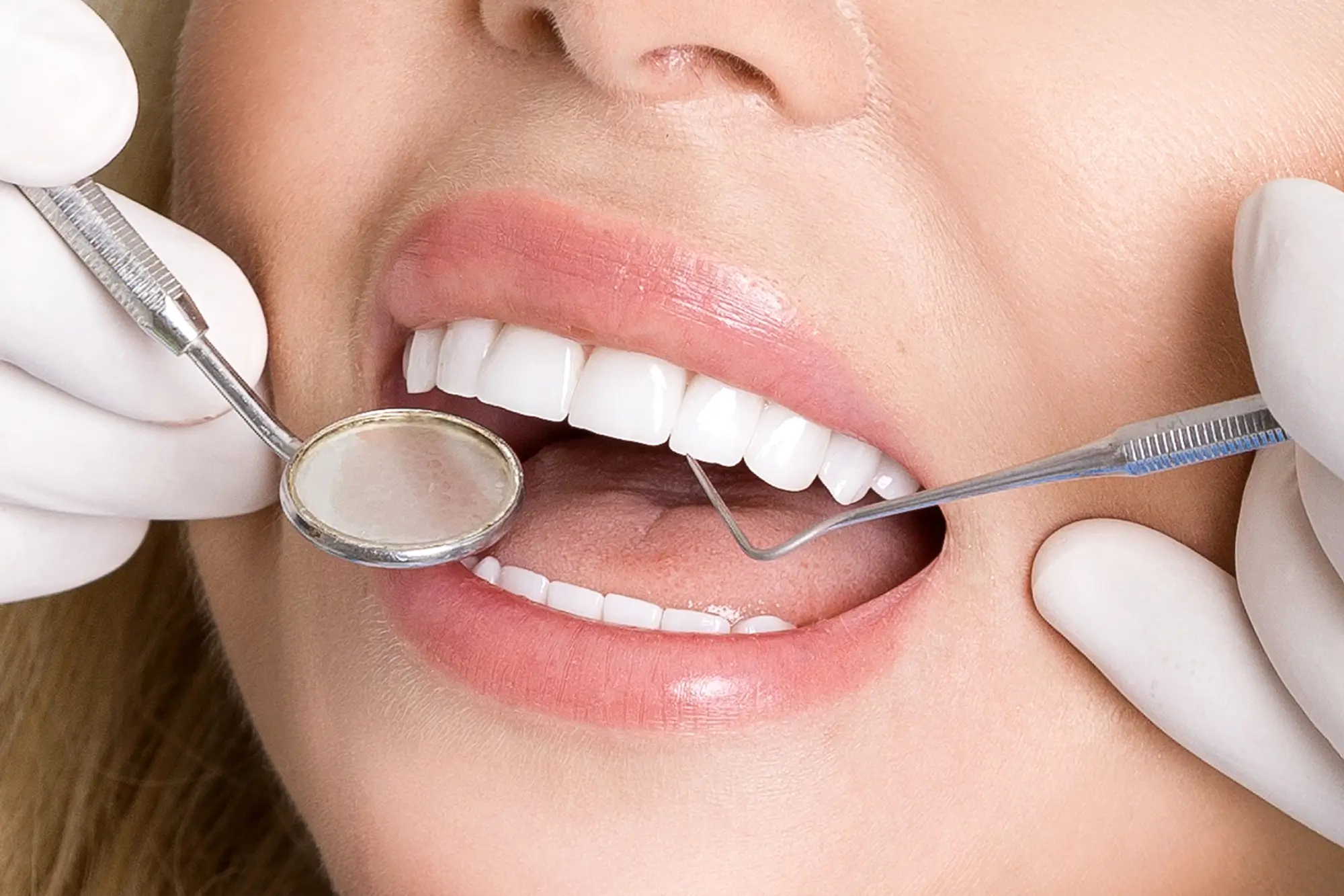 Woman Receiving Canton Veneers Treatment