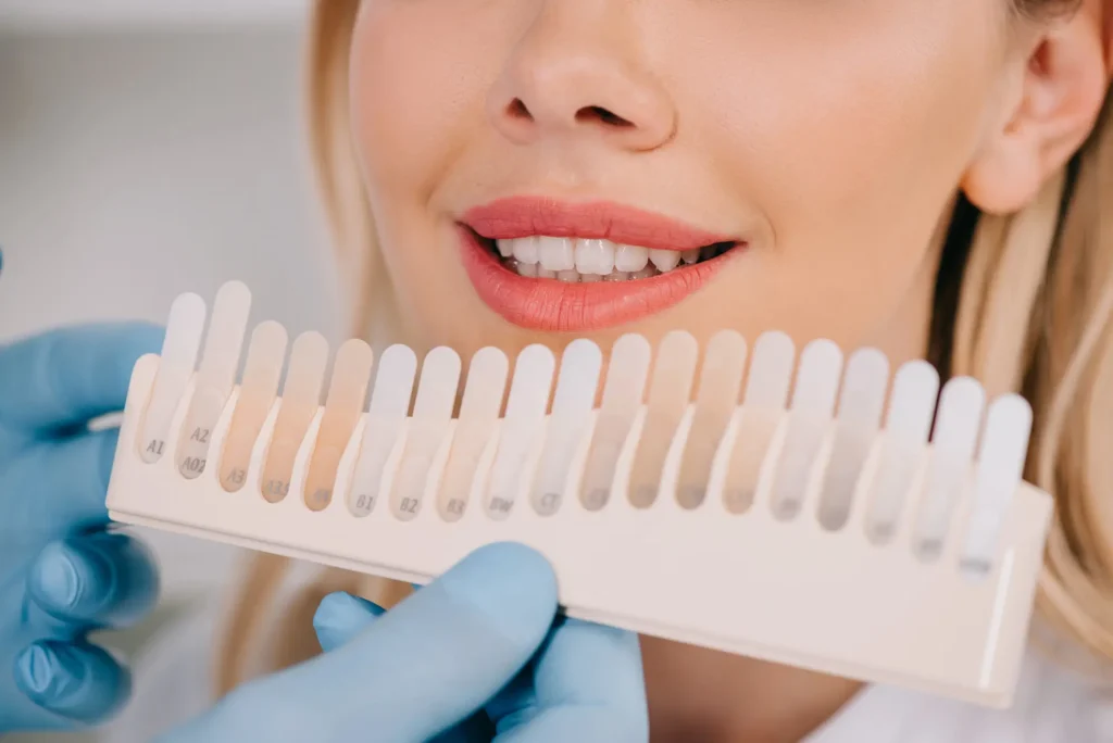 Shade Matching For Teeth Whitening In Canton