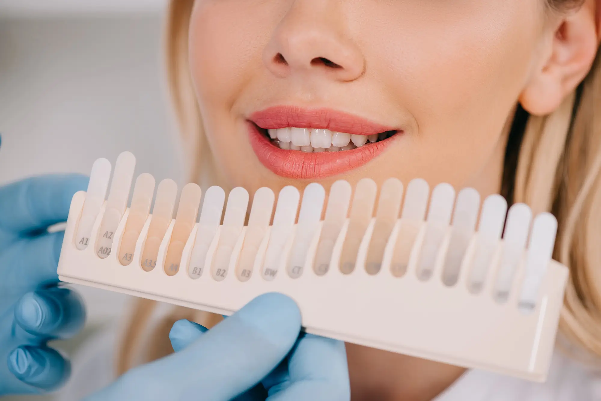 Shade Matching For Teeth Whitening In Canton