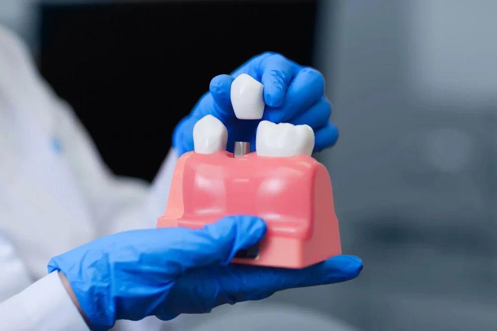Tooth Restoration With Dental Implants In Canton